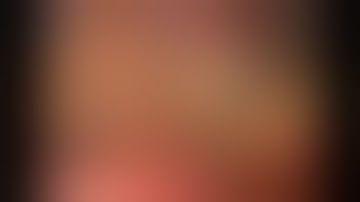 Video vats4all subxiphoid thymectomy