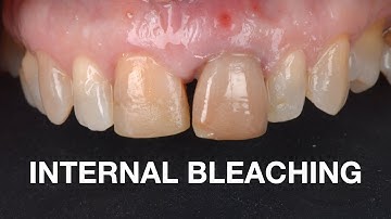 Internal Bleaching Protocol