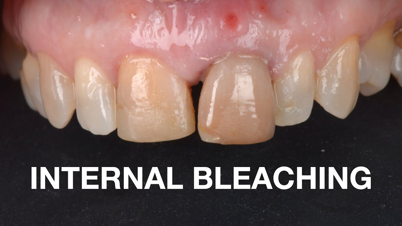 Internal Bleaching Protocol YouTube