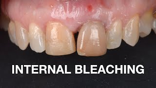 Internal Bleaching Protocol