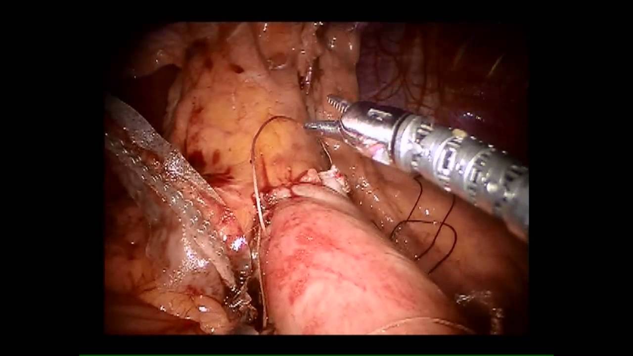 Revision of a Sleeve Gastrectomy to RYGB houston zoo