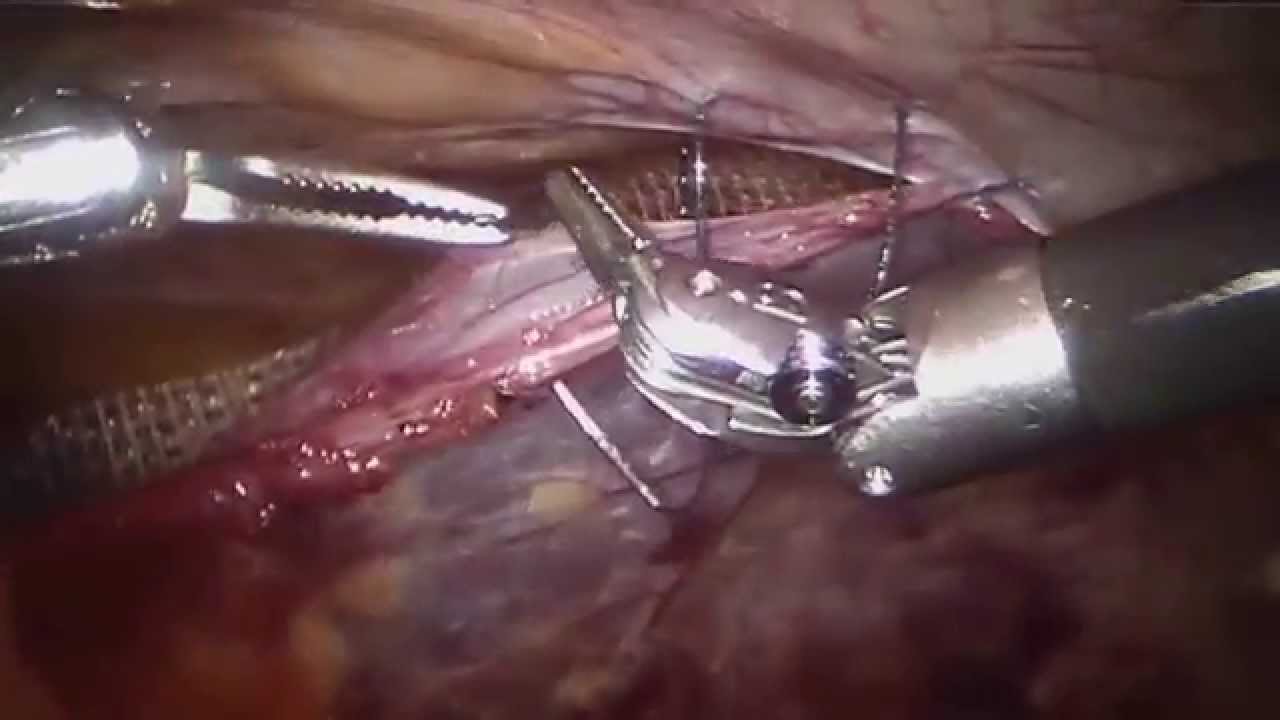 video phone lyrics Robotic Bilateral Inguinal Hernia Repair (r-TAPP). Progrip Mesh