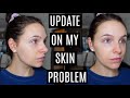 VLOG: update on my skin problem, packing for vacation + jimmy buffett craziness