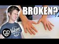 Another Kid Broken Bone | Is it Broken or Sprained? | His First Broken Bone?