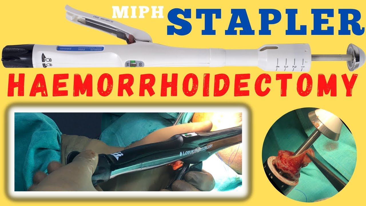 Stapler Haemorrhoids Stapler surgery for piles MIPH YouTube