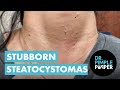 Stubborn Steatocystomas! Dr Pimple Popper PATIENTLY Work On Sweet Woman&#39;s Neck