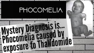 Phocomelia And Teratogenicity-Easiest Explanation
