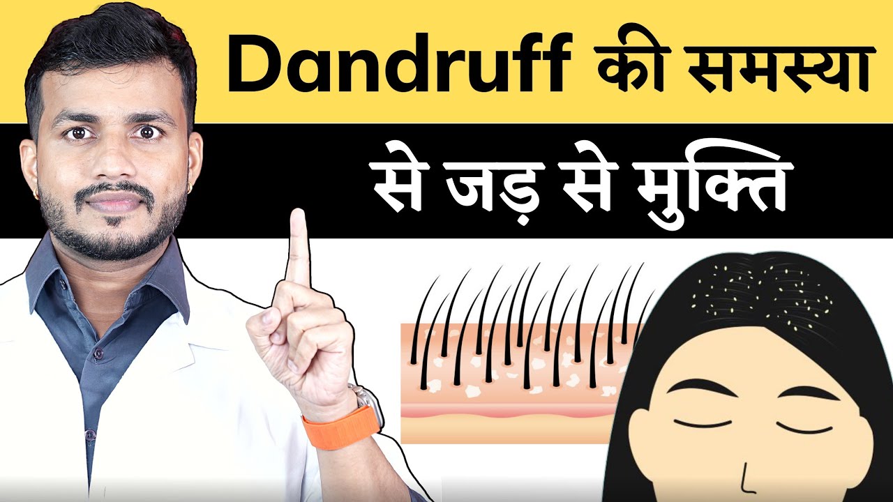 OH Noo😢 DANDRUFF Fir se KYA KARU|| GET Rid of Dandruff (Ayurved Methods) BY DR Arun Mishra  | Ep66