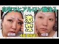 【検証】激やば！4日間自宅でヒアルロン酸注入してみた！
