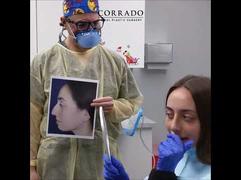 Video thumbnail: Rhinoplasty Reveal 1 Week Post Op: "OMG! There's No Bump!" – Before and After | Dr. Anthony Corrado · Dr. Anthony Corrado