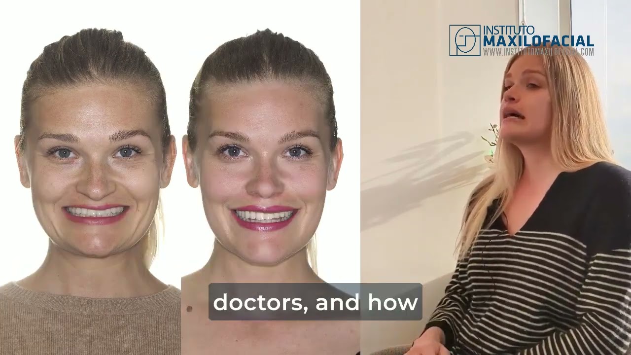 Bimaxillary Surgery Case #145: Diana - Short face