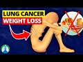 Unexplained Weight Loss = Lung Cancer? | Cachexia