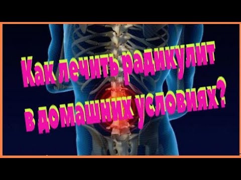 Как быстро снять радикулит