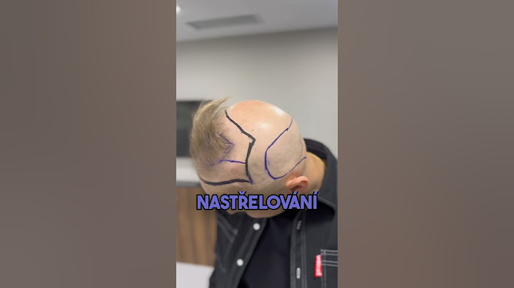 JAK PROBÍHÁ NASTŘELOVÁNÍ/TRANSPLANTACE VLASŮ ?! PART 1 #vlasy #transplantace #hair