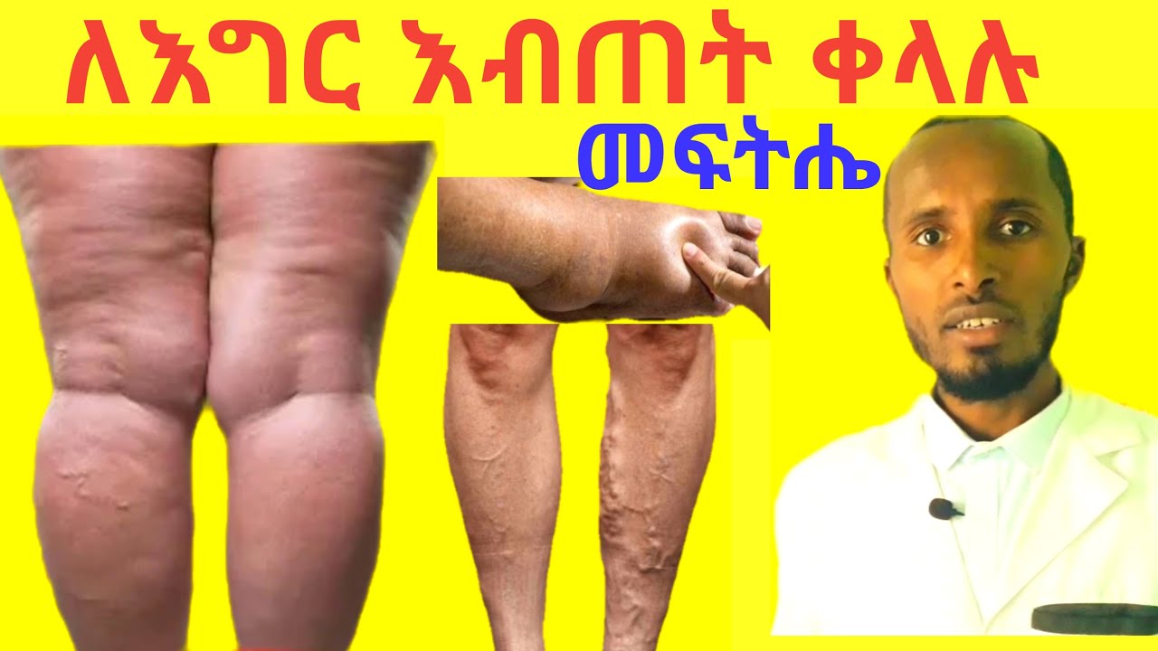 የእግር እብጠት ቀላል ተፈጥሮአዊ መፍትሄዎች Leg swelling and Edema Causes and Natural Treatments