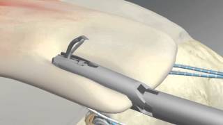 MultiFIX P