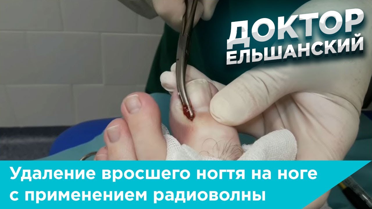 Операция по удалению вросшего ногтя на ноге с применением радиоволны