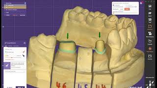 EXOCAD tutorials How to use Crown Bottoms and insertion direction  | Part 4