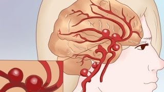 Cuestionario los casos, cerebrovascular la por un causada la demencia de es en mayoría