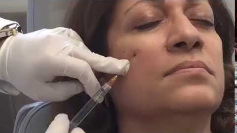 Under-Eye Rejuvenation with Cannula Technique
