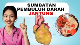 9 Cara Mengurangi Penyumbatan Plak Pembuluh Darah Jantung Iskemik Secara Alami | dr.Emasuperr