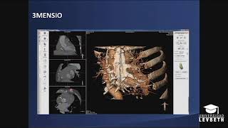 Análisis tomográfico paso a paso para procedimiento TAVI | Dr. Óscar Millán screenshot 5