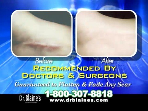 scars scar treatment scar care dr blaines complete scarcare cvs scar treatment silicone sheets review