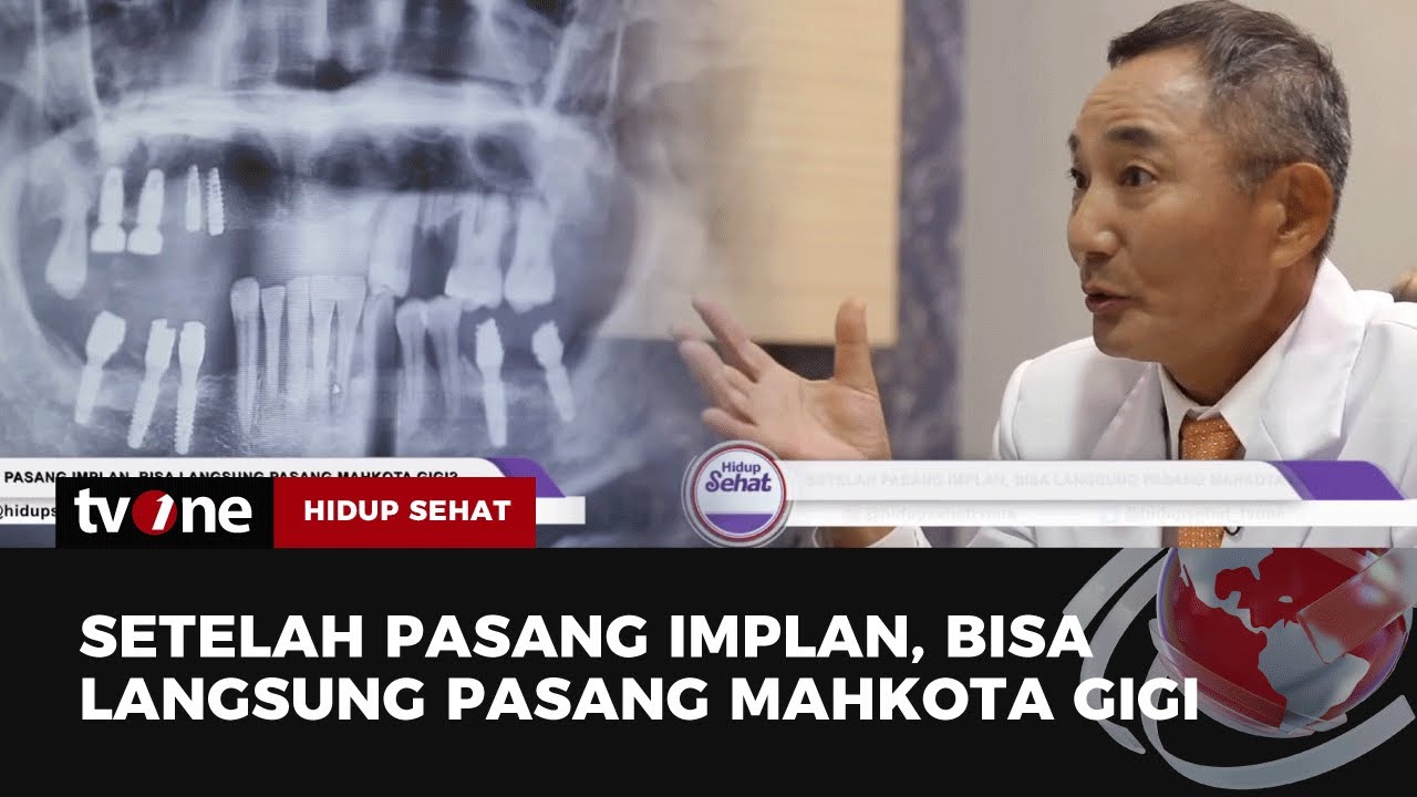 Setelah Pasang Implan, Bisa Langsung Pasang Mahkota Gigi? | Hidup Sehat tvOne