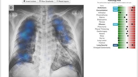 Chester the AI Radiology Assistant (V3)