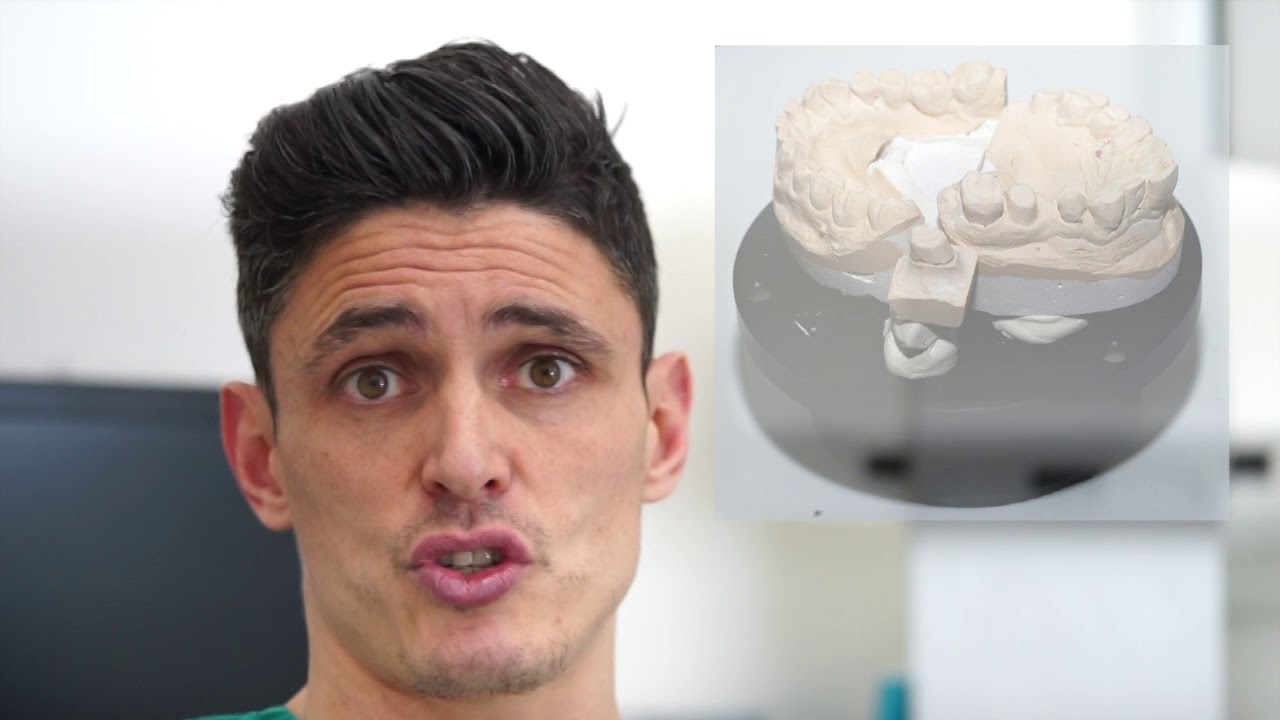 Dente singolo ottimizzato