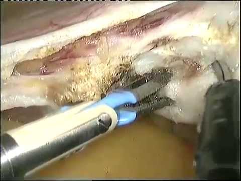 TLH Simple Laparoscopic Hysterectomy