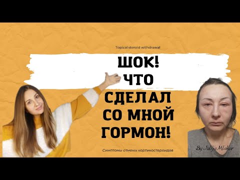 😱🤬Последствия применения ГОРМОНАЛЬНОЙ МАЗИ. Атопический дерматит и экзема.TSW. Часть 2.