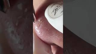 Acne treatment Mai Ngoc Da Nang #điềutrịmụn #acnetreatment #maingoc #acne