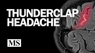 Thunderclap Headache