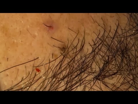 HAIR REMOVAL INGROWN ASMR 15