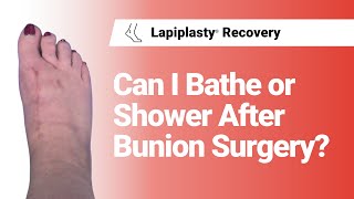 Can I Bathe Or Shower After Bunion Surgery? | Lapiplasty® Recovery Net Worth