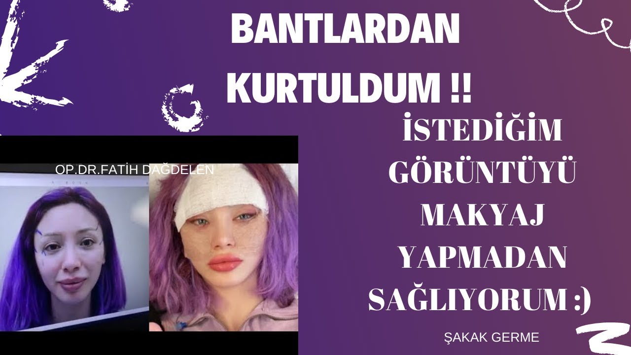 Badem Göz Estetiği II  ŞAKAK GERME - ÖNCESİ - SONRASI SÜREÇLERİM @uzunmakarnaofficial