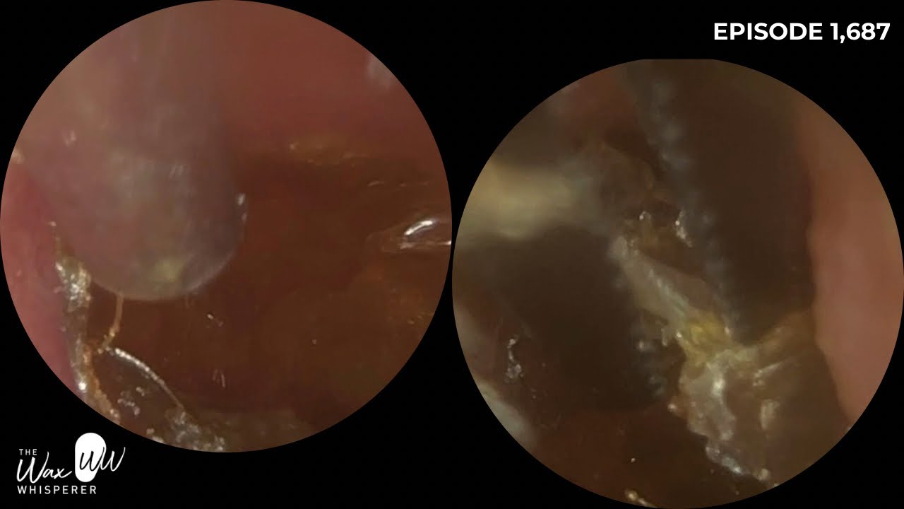 1,687 - Hard as Rock Ear Wax Removal & Crystallised Dead Skin Peel