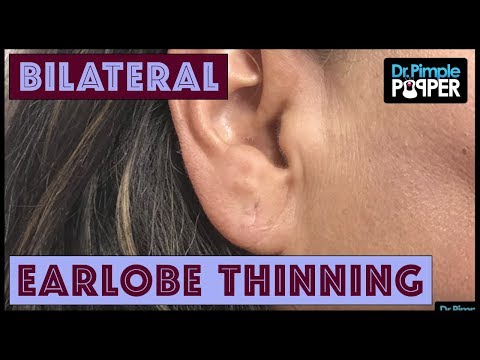 Some People Don't Like Their Earlobes... With Dr Pimple Popper