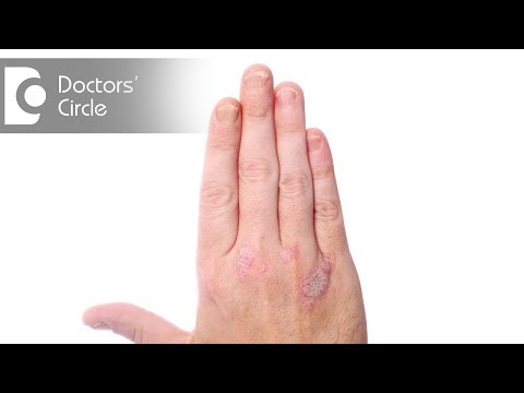 Is Psoriasis contagious? - Dr. Suresh G