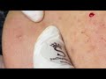 Extractions And Acne  - ThuyTruong#101