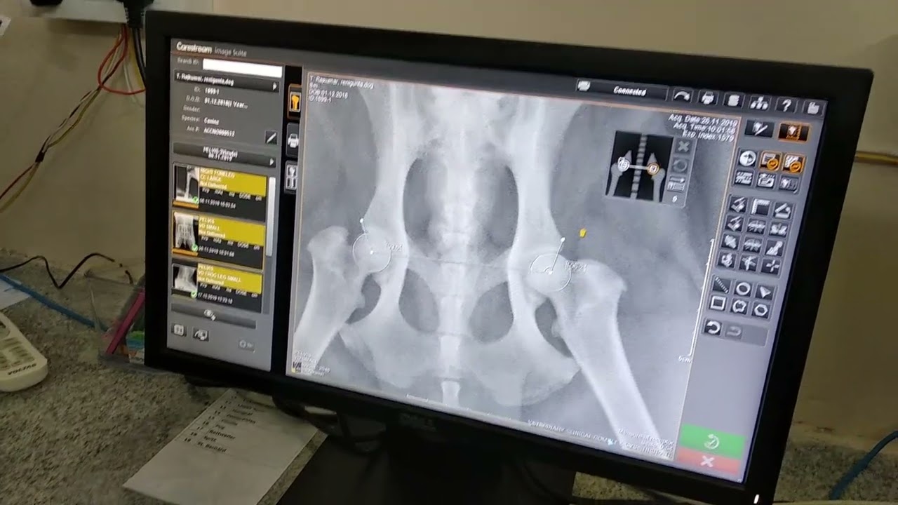 NORBERGS ANGLE @dx of Hip dysplasia(HD).        #