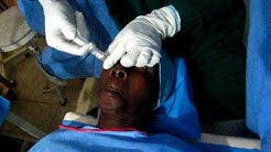 Anesthesia injection in the eyes for cataract surgery