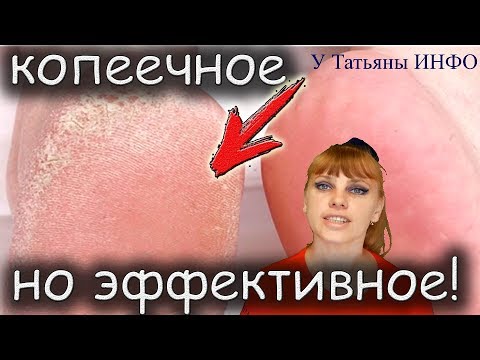 КОПЕЕЧНОЕ и ЭФФЕКТИВНОЕ средство от МОЗОЛЕЙ и НАТОПТЫШЕЙ!!!