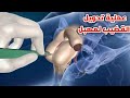 شاهد عمليه تحويل العضو الزكري ل عضو أنثوي|جراحه تحول الرجل لأمرأه_Surgery to convert penis to vagina