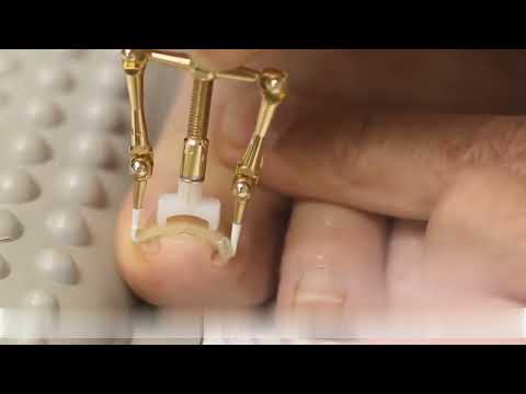 Металічний фіксатор коректор врослого нігтя Toenail Corrector, видео 1