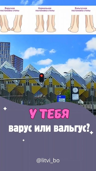#варус #вальгус #стопа #лечениеног #тейпирование #тейпированиеног #тейп ...
