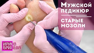 Мужской педикюр 🌸 Старые мозоли