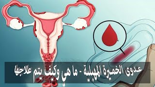 عدوى الخميرة المهبلية   ما هي وكيف يتم علاجها