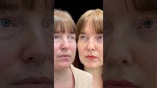 ВСЕГДА ЛИ НУЖЕН РАЗРЕЗ❓ #plastic #beforeandafter #makeup #допосле #мешкиподглазами #блефаропластика